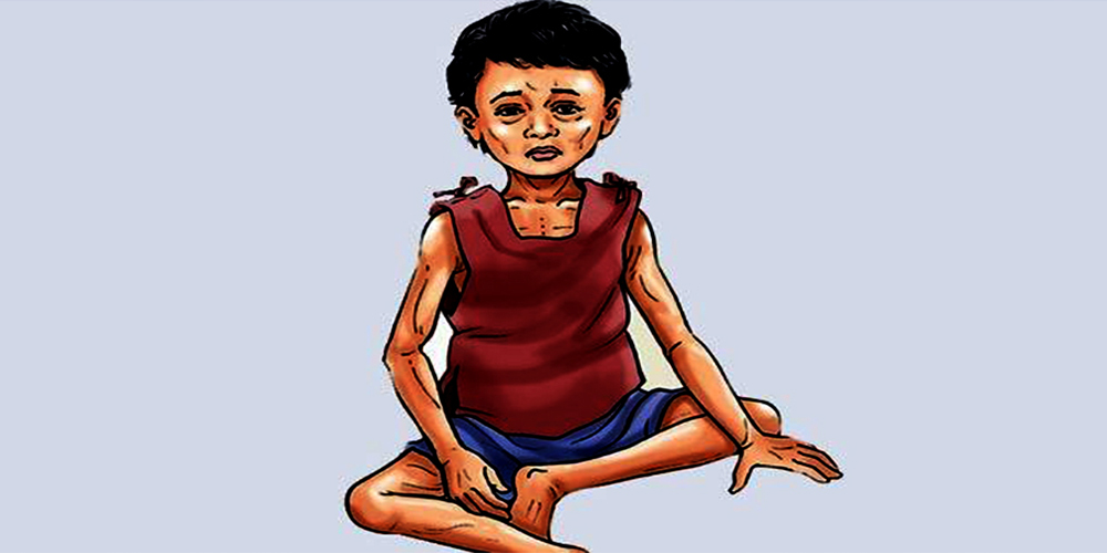 बालबालिकामा कुपोषण बढ्यो